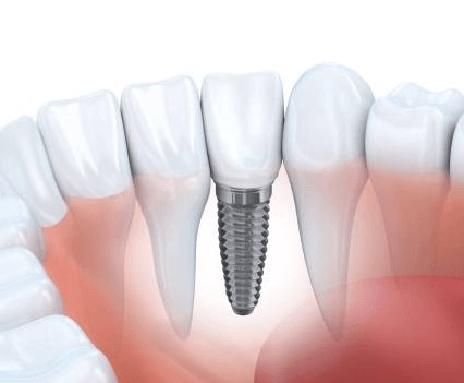 Unveiling the Magic of Dental Implants in Houston with Complete Dental